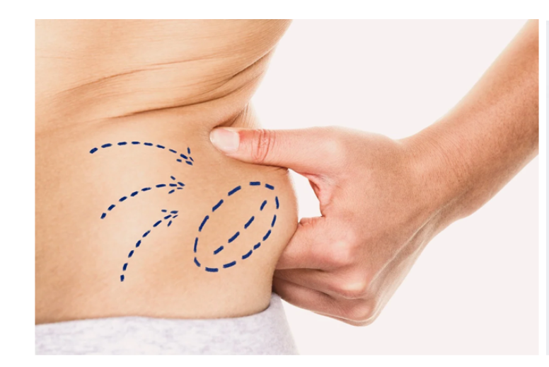 Inyecciones de Reducción de Grasa Localizada